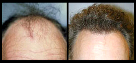 NeoGraft Hair Replacement Hair Restoration in Savannah, GA and Hilton Head, SC
