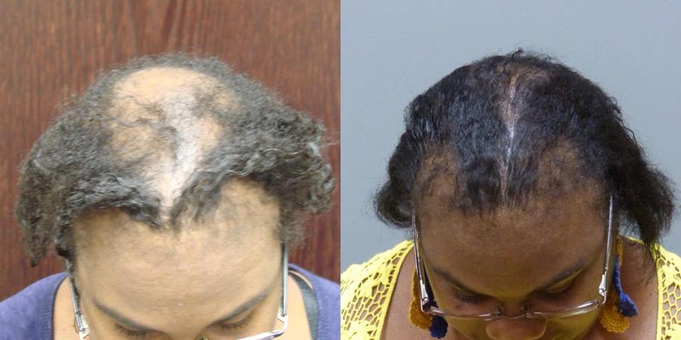 African American Hair Replacement in Savannah and Hilton Head