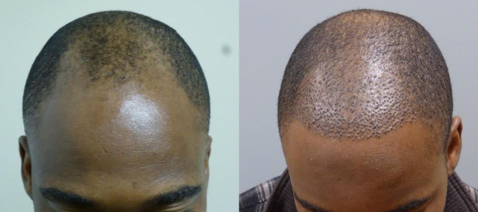 African American Hair Restoration in Savannah and Hilton Head