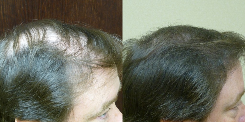 2500 Grafts Before & After (12 months later)