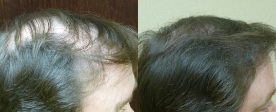Hair Loss Questions and Answers