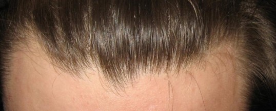 When Hair Transplant May Not be a Good Idea
