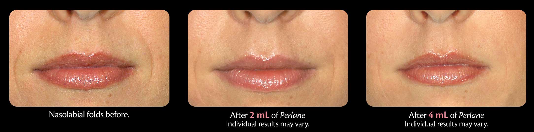 Perlane Treatment before and after