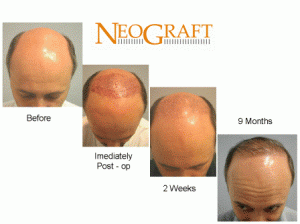 NeoGraft Hair Restoration Procedure