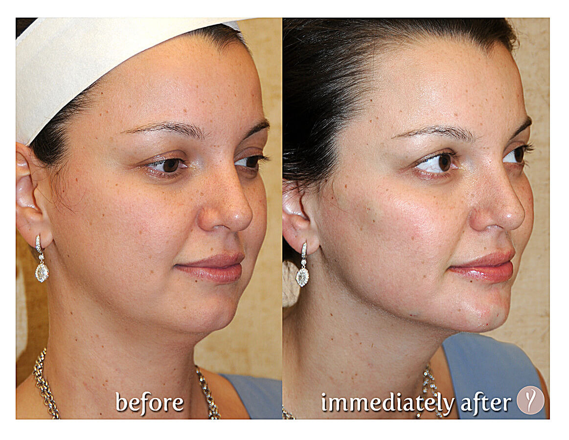 Say Yes to the Y LIFT. Say Yes to a more Youthful Natural Result. Say Yes to the Y LIFT. Say Yes to a more Youthful Natural Result.