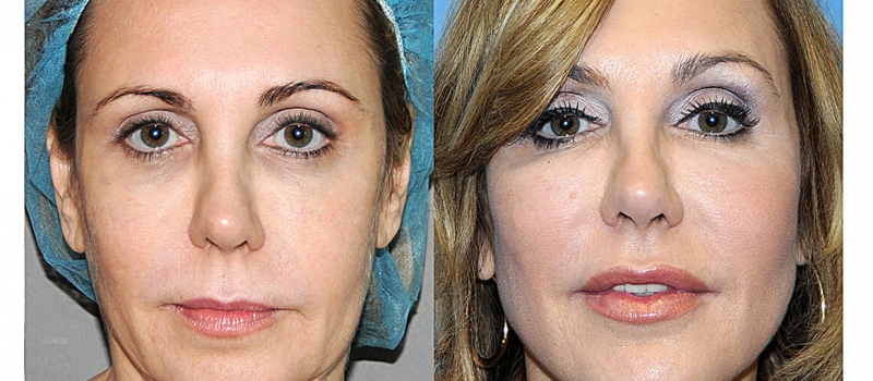 Say Yes to the Y LIFT. Say Yes to a more Youthful Natural Result. Say Yes to the Y LIFT. Say Yes to a more Youthful Natural Result.