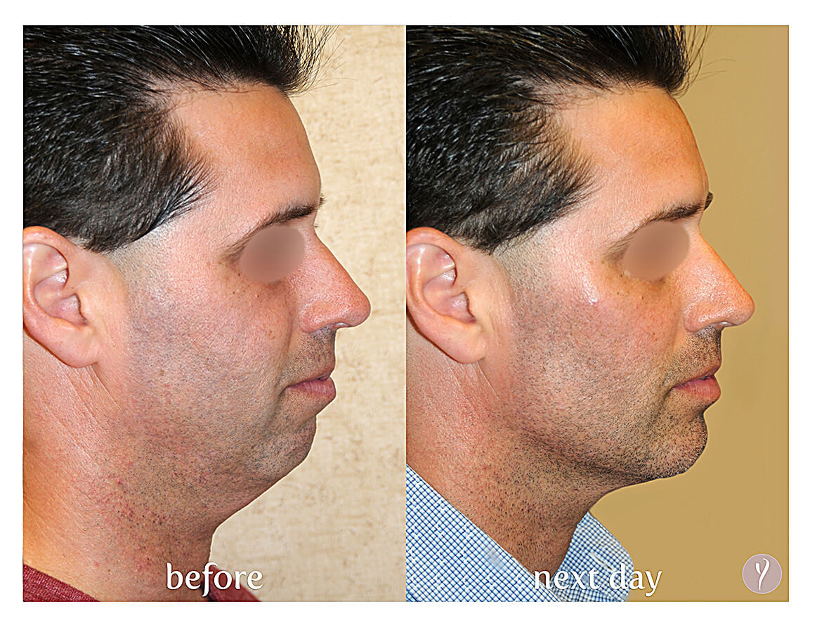 Say Yes to the Y LIFT. Say Yes to a more Youthful Natural Result. Say Yes to the Y LIFT. Say Yes to a more Youthful Natural Result.