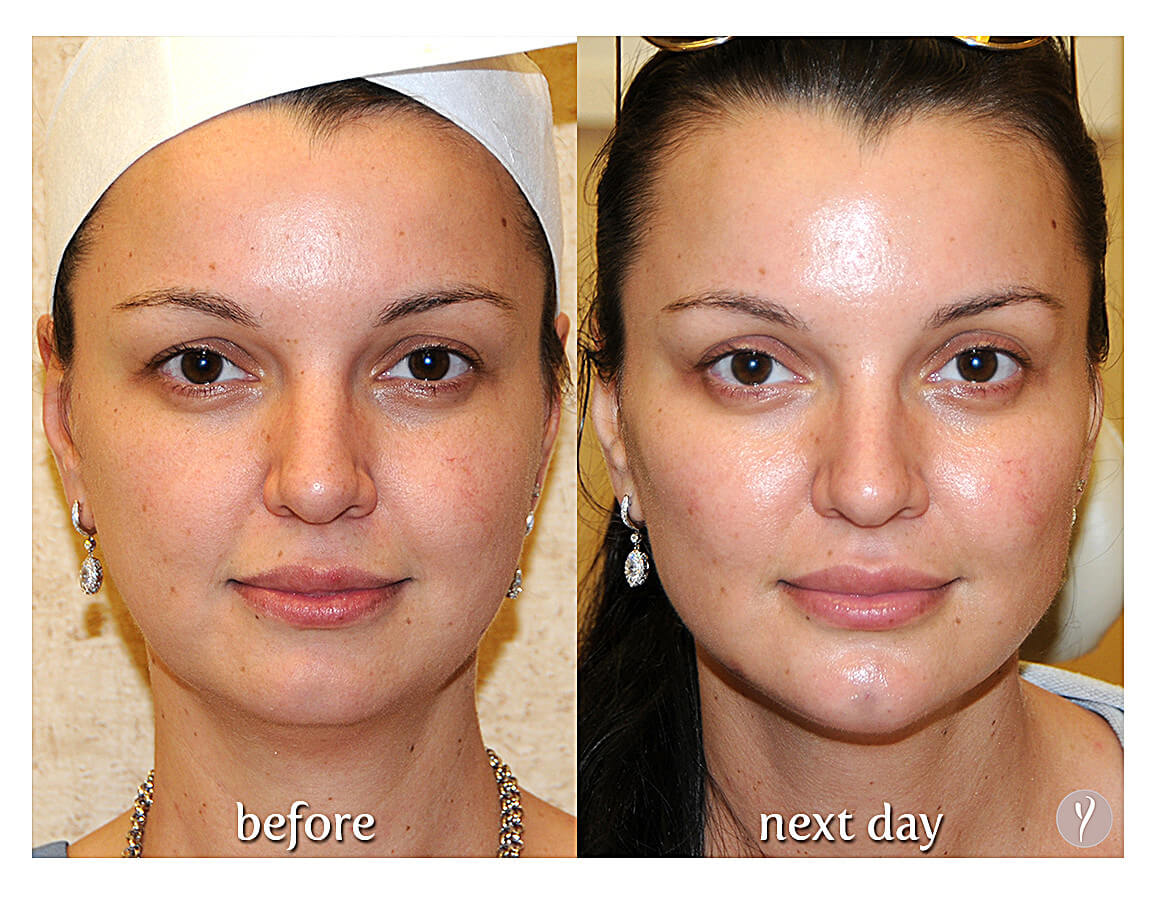 Say Yes to the Y LIFT. Say Yes to a more Youthful Natural Result. Say Yes to the Y LIFT. Say Yes to a more Youthful Natural Result.