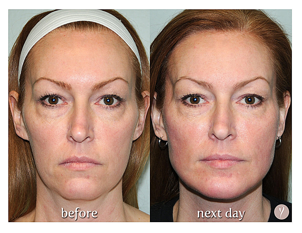 Say Yes to the Y LIFT. Say Yes to a more Youthful Natural Result.