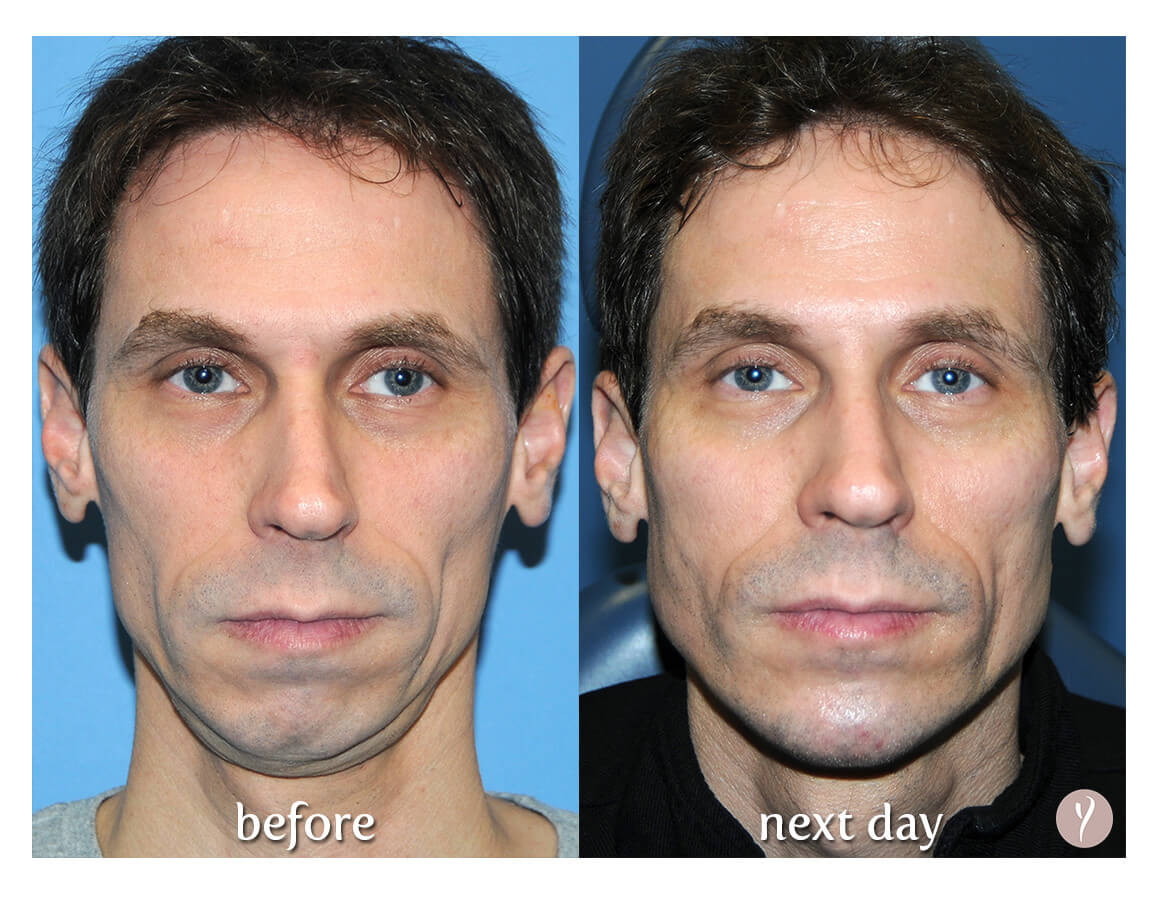 Say Yes to the Y LIFT. Say Yes to a more Youthful Natural Result. Say Yes to the Y LIFT. Say Yes to a more Youthful Natural Result.