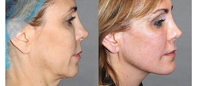 Say Yes to the Y LIFT. Say Yes to a more Youthful Natural Result. Say Yes to the Y LIFT. Say Yes to a more Youthful Natural Result.