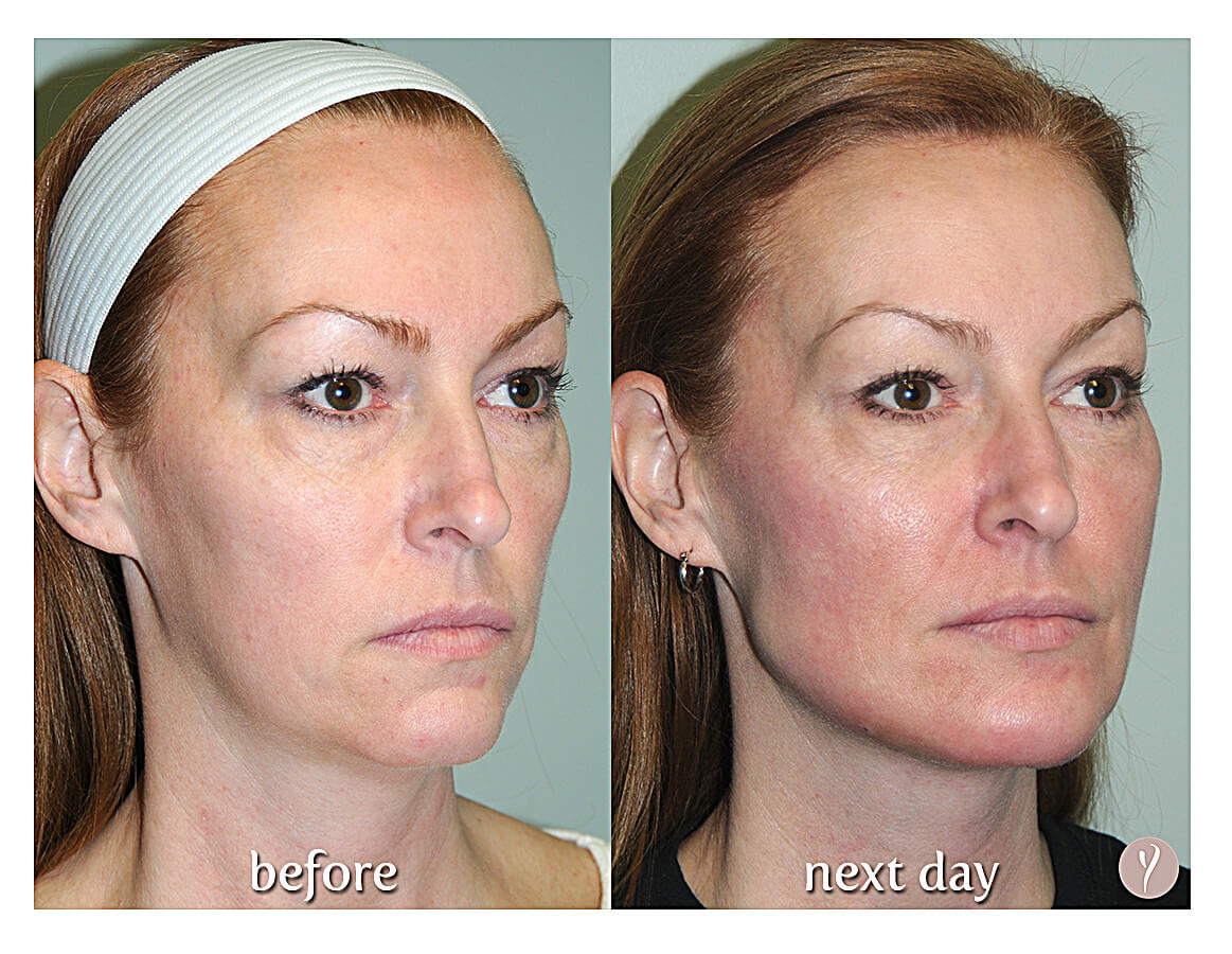 Say Yes to the Y LIFT. Say Yes to a more Youthful Natural Result. Say Yes to the Y LIFT. Say Yes to a more Youthful Natural Result.