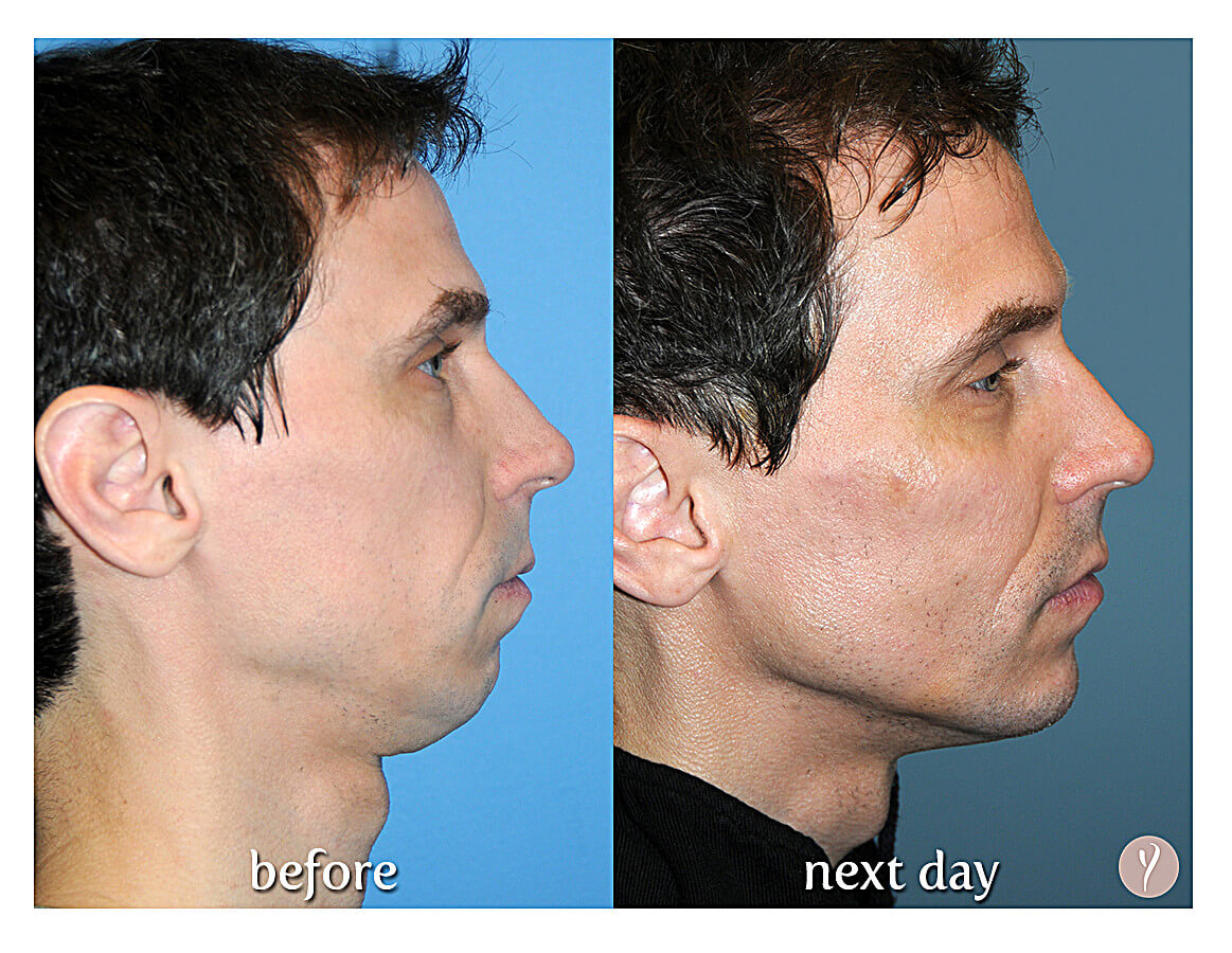 Say Yes to the Y LIFT. Say Yes to a more Youthful Natural Result. Say Yes to the Y LIFT. Say Yes to a more Youthful Natural Result.