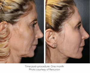 The Renuvion Plasma Pen is ideal for the lower face and neck. Look at these amazing results. Before and after one month of the procedure. Renuvion RF Device offered at New Youth Medical Spa for Skin Tightening in Savannah