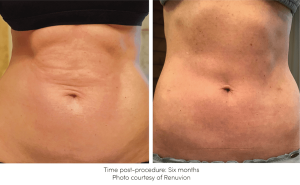 The Renuvion Plasma Pen (formerly J-Plasma) can tighten, and lift the skin in various areas of the body. Renuvion RF Device offered at New Youth Medical Spa for Skin Tightening in Savannah