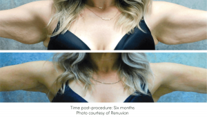Renuvion is ideal for the lower for the arms. Look at these amazing results. Before and after 6-months of the procedure. Renuvion RF Device offered at New Youth Medical Spa in Savannah, GA