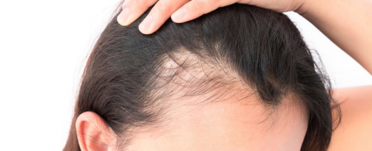 These Hair Loss Products could be better than Minoxidil (Rogaine)