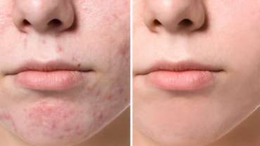 Micro-needling RF can be extremely helpful in treating acne and acne scars