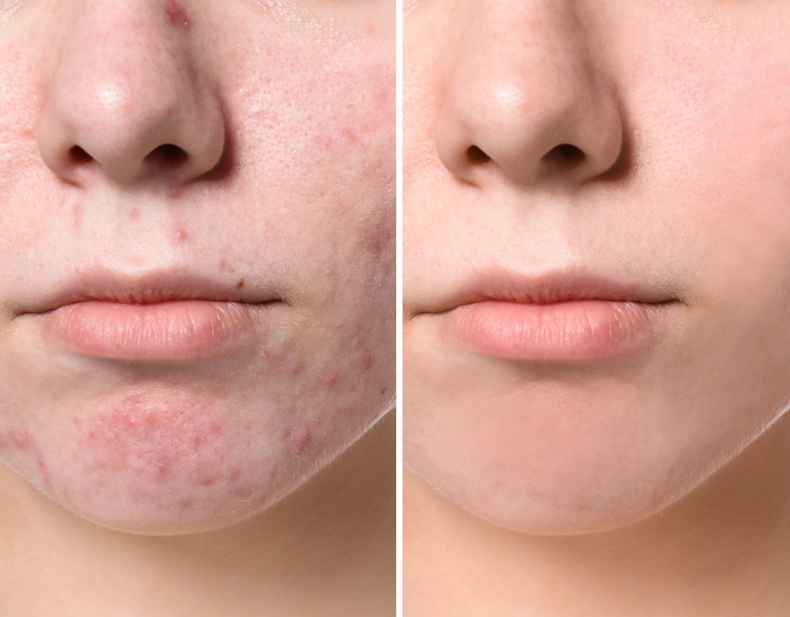 Micro-needling RF can be extremely helpful in treating acne and acne scars