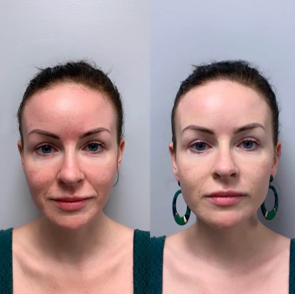 Before and After one BB-Glow Facial by Tiffany Smith. 3 Treatments for Best Results and Flawless Coverage are recommended.