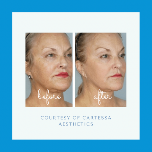 Before and after CoolPeel™ Laser Treatment Before and after CoolPeel Laser Treatment