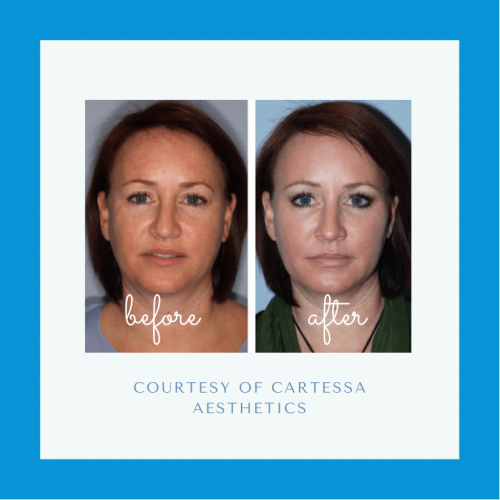 Before and after Tetra CO2 Laser Treatment Before and after Tetra CO2 Laser Treatment