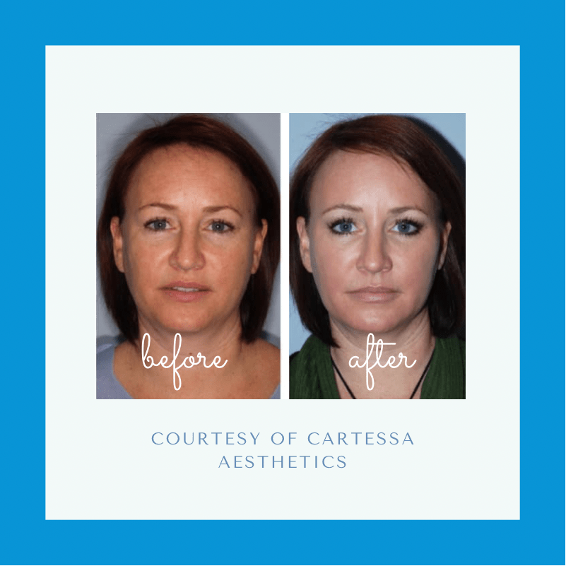 Before and after Tetra CO2 Laser Treatment