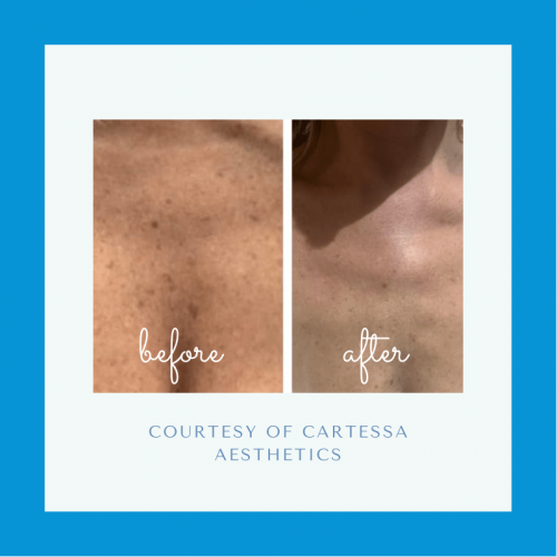 Before and after CoolPeel™ Laser Treatment