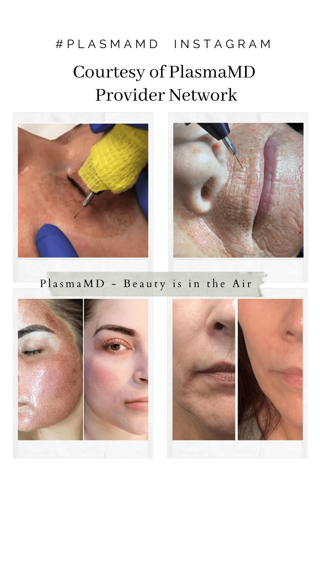 Plasma Treatments - Plasma MD Plasma Treatments are perfect for the eye and mouth area