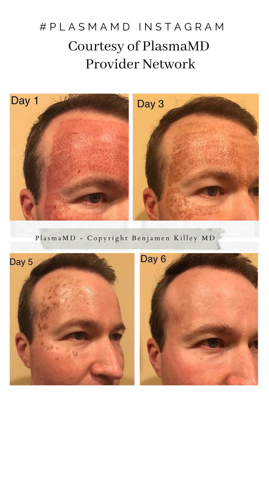 Plasma Treatments Plasma Treatments for wrinkles and fine lines - Plasma MD