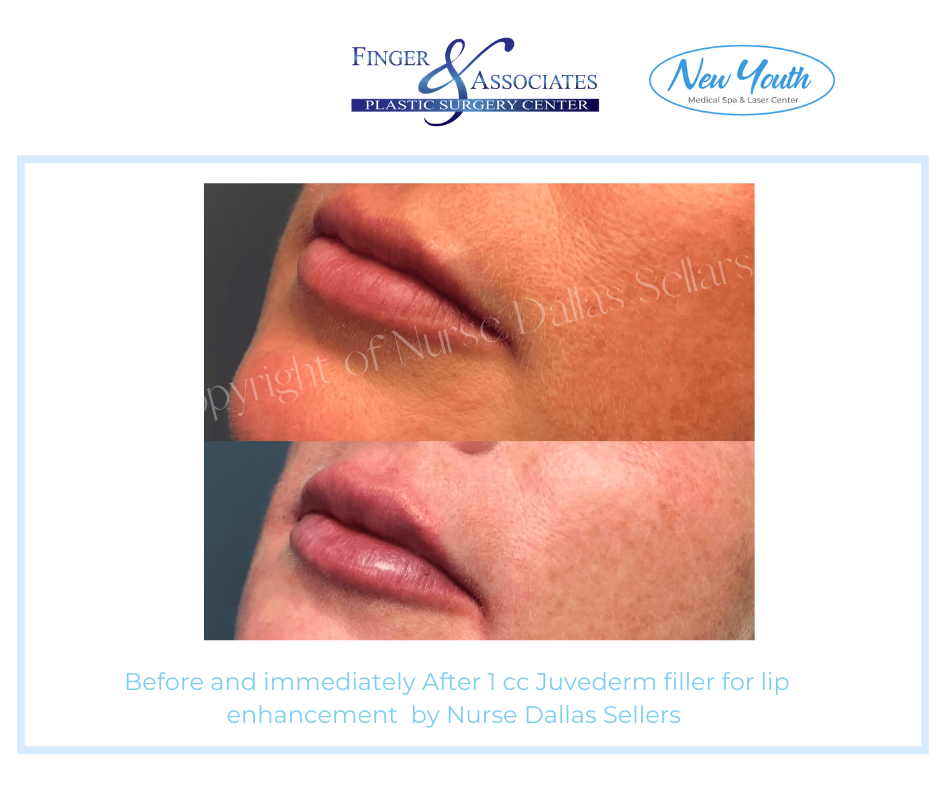 Lip filler by Nurse Injector Dallas Sellars