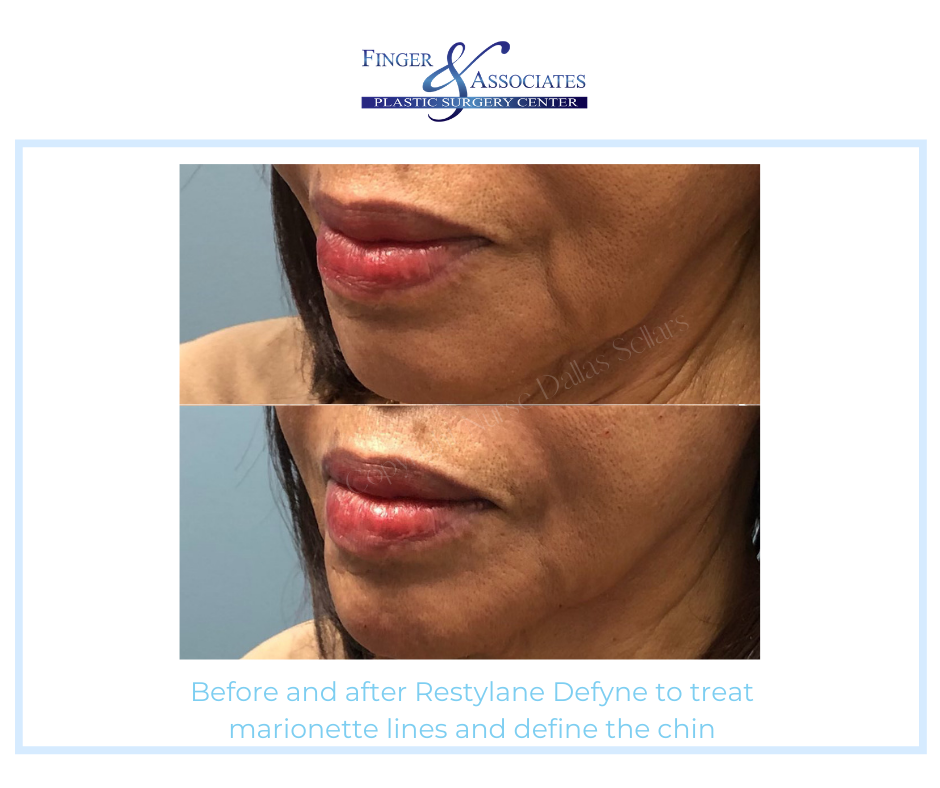 Before and after Restylane by Nurse Injector Dallas Sellars
