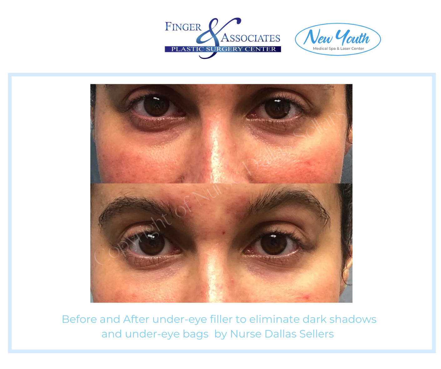 Before and after Restylane Lyft under Eye filler by Nurse Injector Dallas Sellars