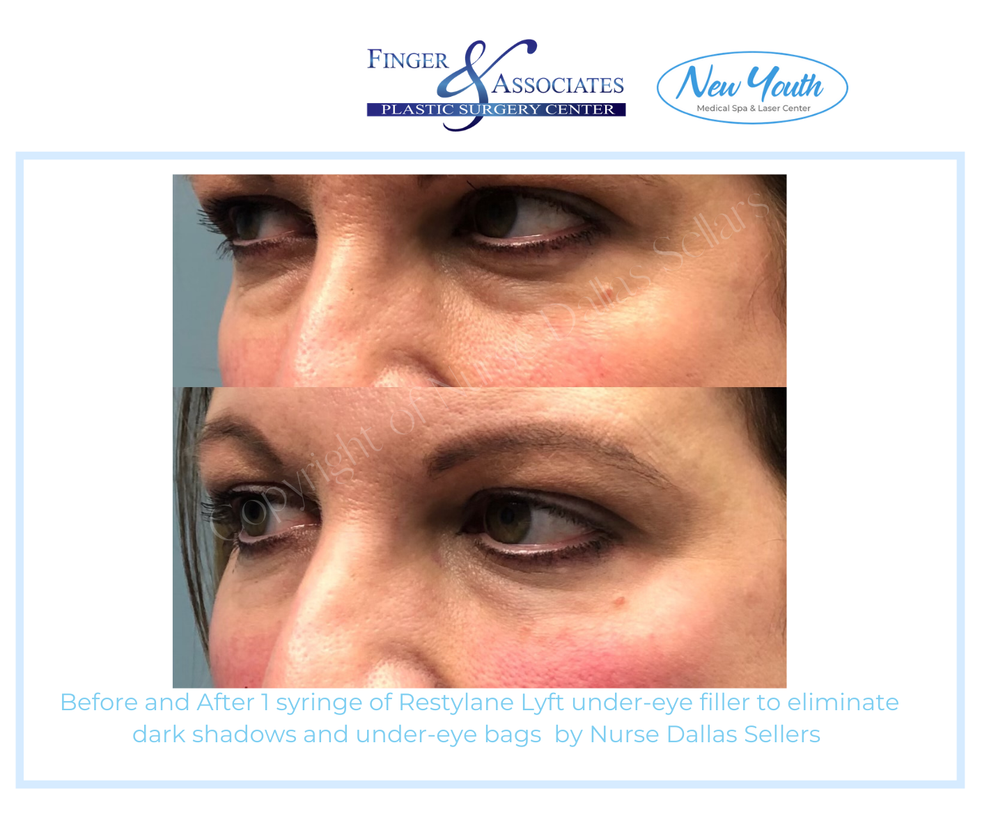 Before and after Restylane Lyft under Eye filler by Nurse Injector Dallas Sellars