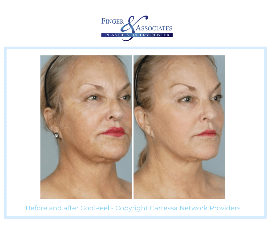 Cartessa Patient Before an After Receiving CoolPeel for Skin Resurfacing 