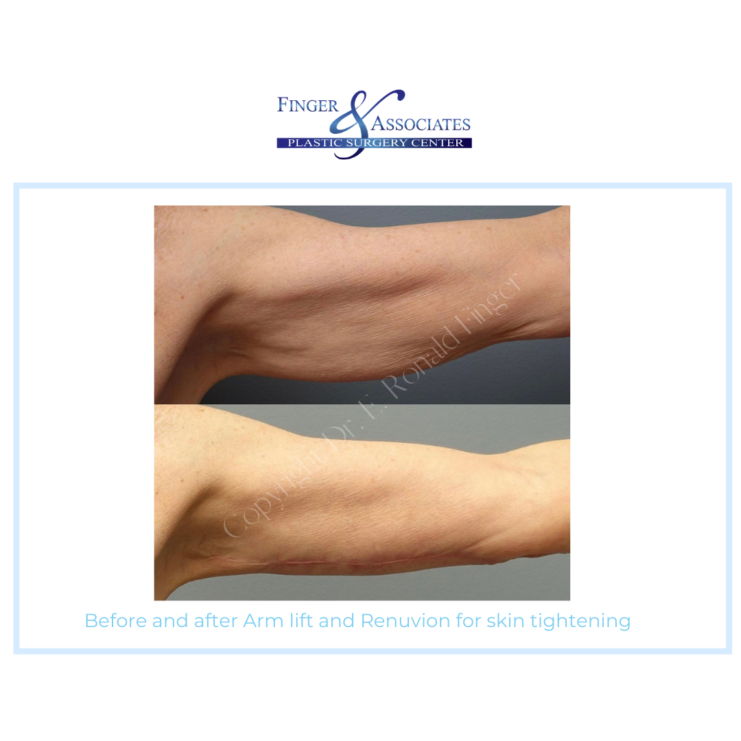 arms before and after skin tightening front view