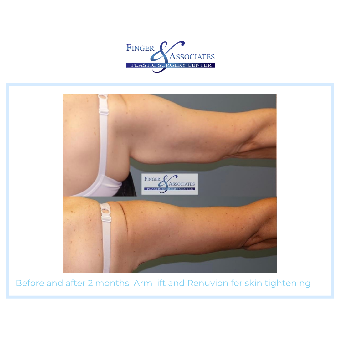 arms before and after skin tightening procedure