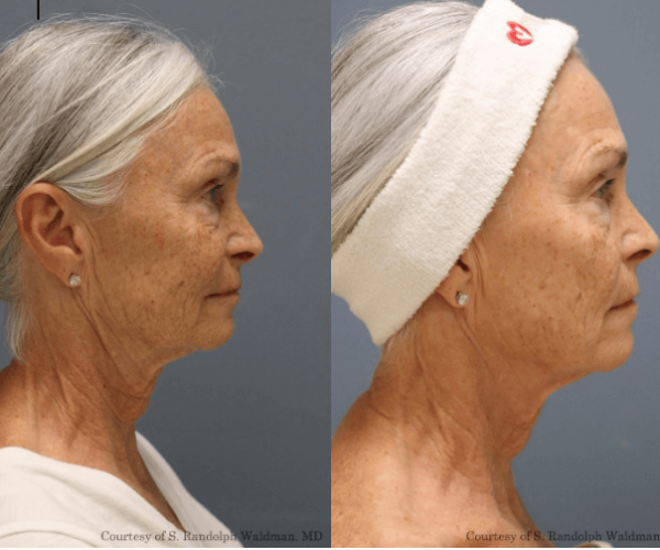 Cartessa Patient Before and After Receiving Pixel 8 Microneedling - available at New Youth Med Spa 