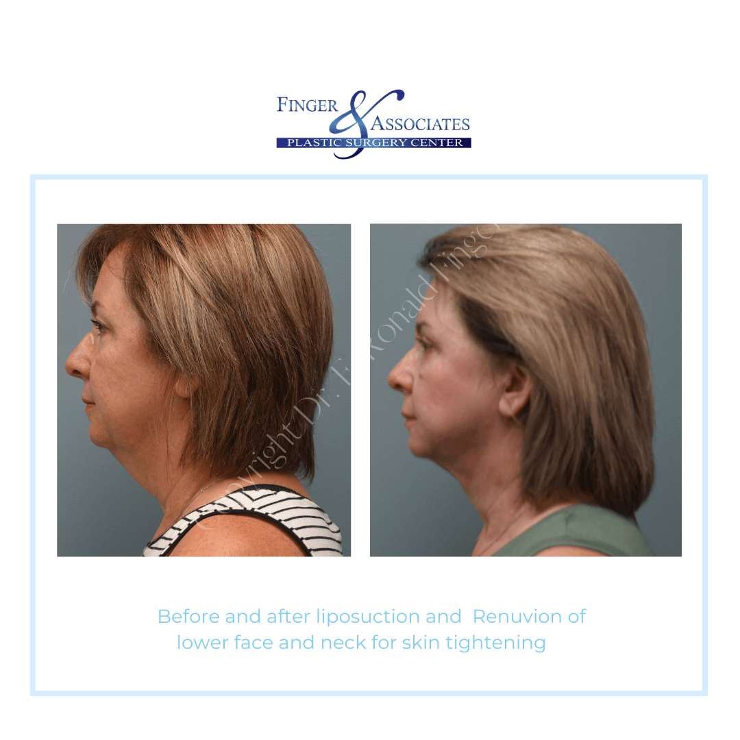 superior results of double chin reduction and skin tightening - lipo and Renuvion by Dr. Finger