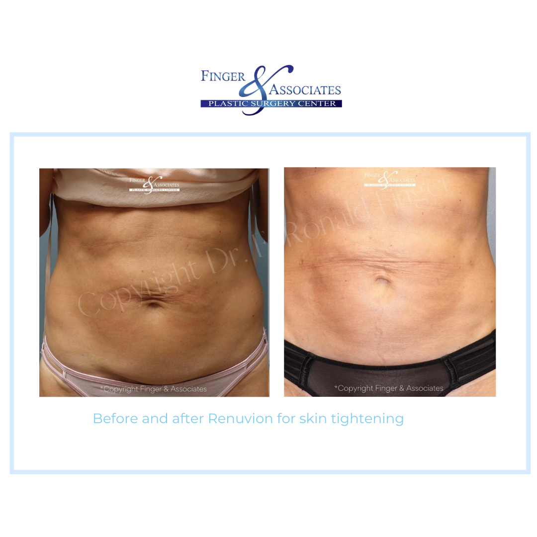 abs of woman before and after skin tightening with Renuvion