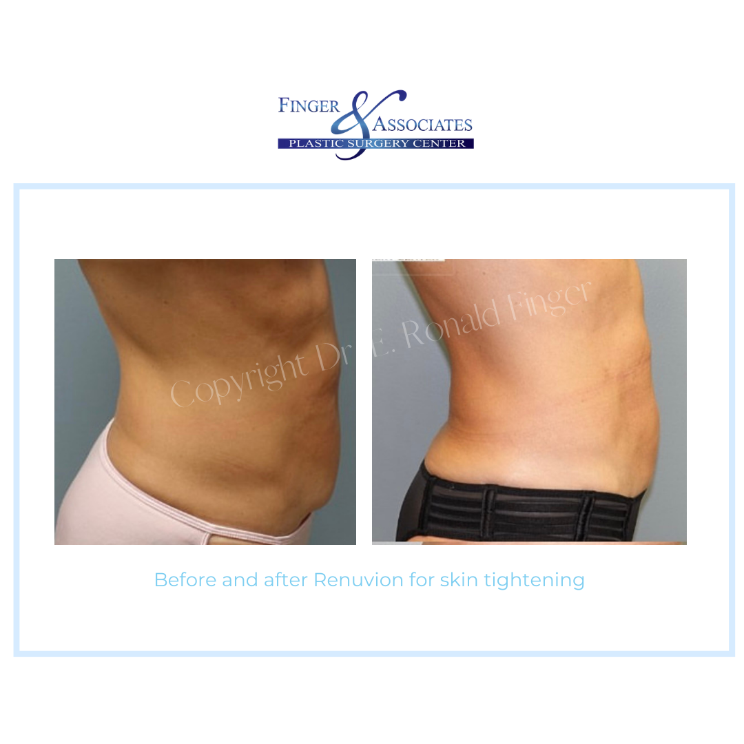 Renuvion for skin tightening showing woman's abs before and after