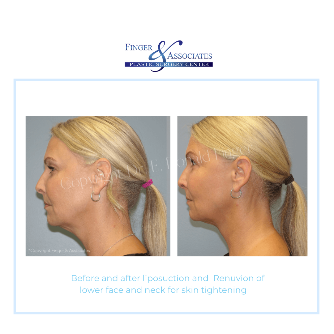 woman side view before and after lipo of the chin and neck with skin tightening with Renuvion