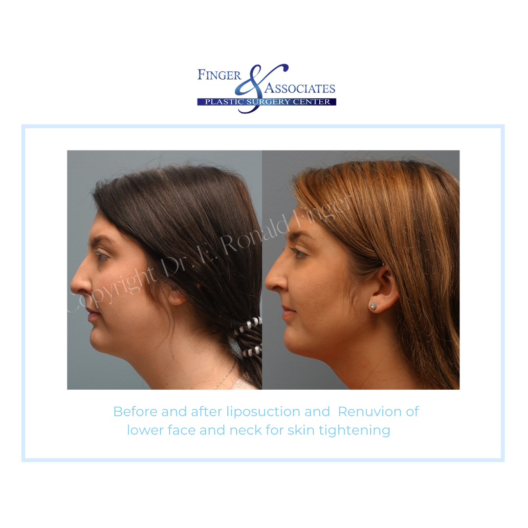woman side view before and after Renuvion for skin tightening