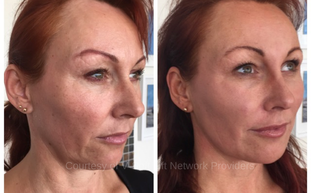 V- Soft Lift Results (3) PDO Threads to lift and tighten skin without surgery