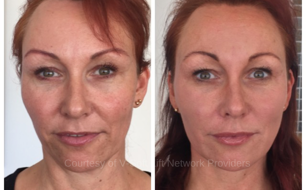 V- Soft Lift Results (4)