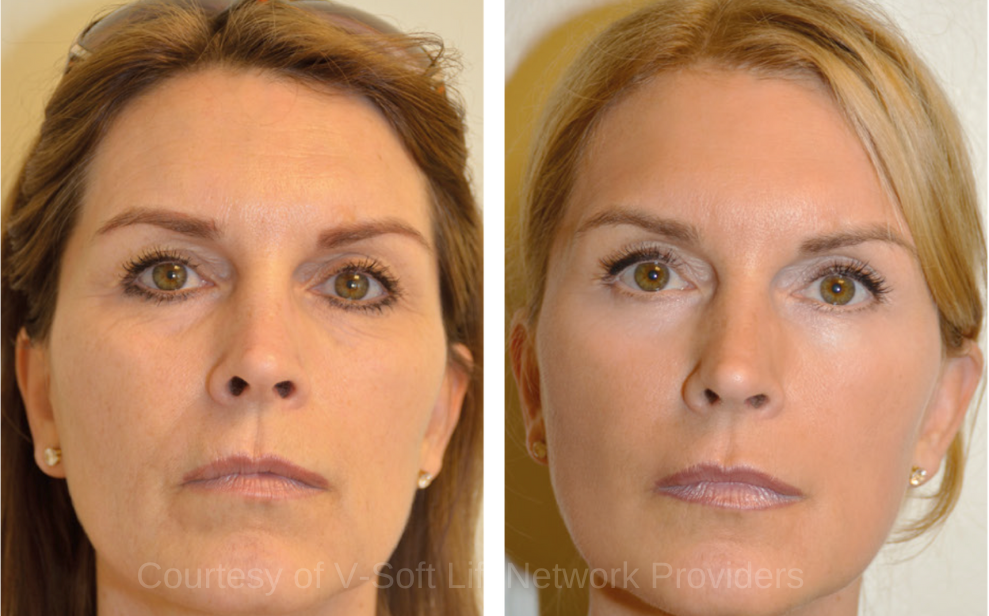 V- Soft Lift Results V-Soft Lift PDO thread Lift Results