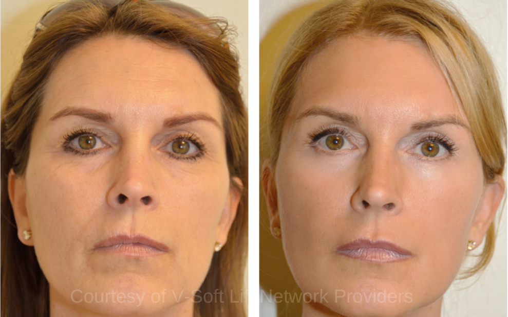 V-Soft Lift PDO thread Lift Results