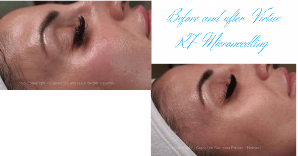 Virtue-RF-Microneedling- Virtue RF Results