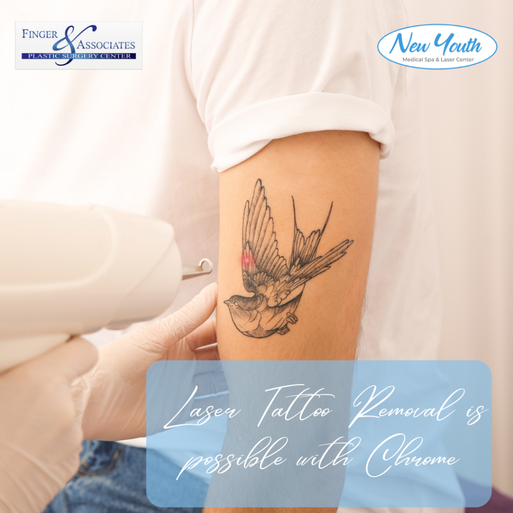 Laser Tattoo Removal possible with chrome at New Youth Medical Spa