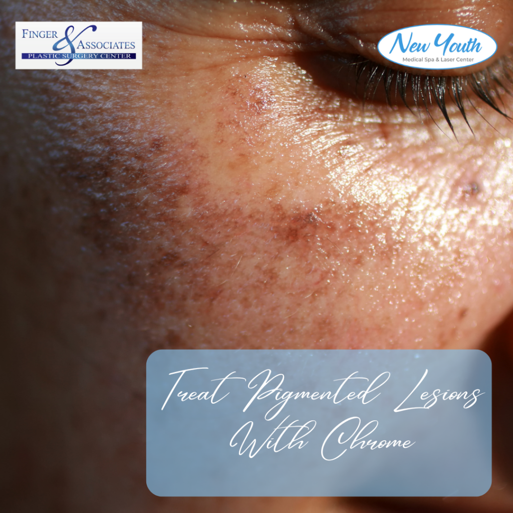 Treat Pigmented Lesions with chrome at New Youth Medical Spa